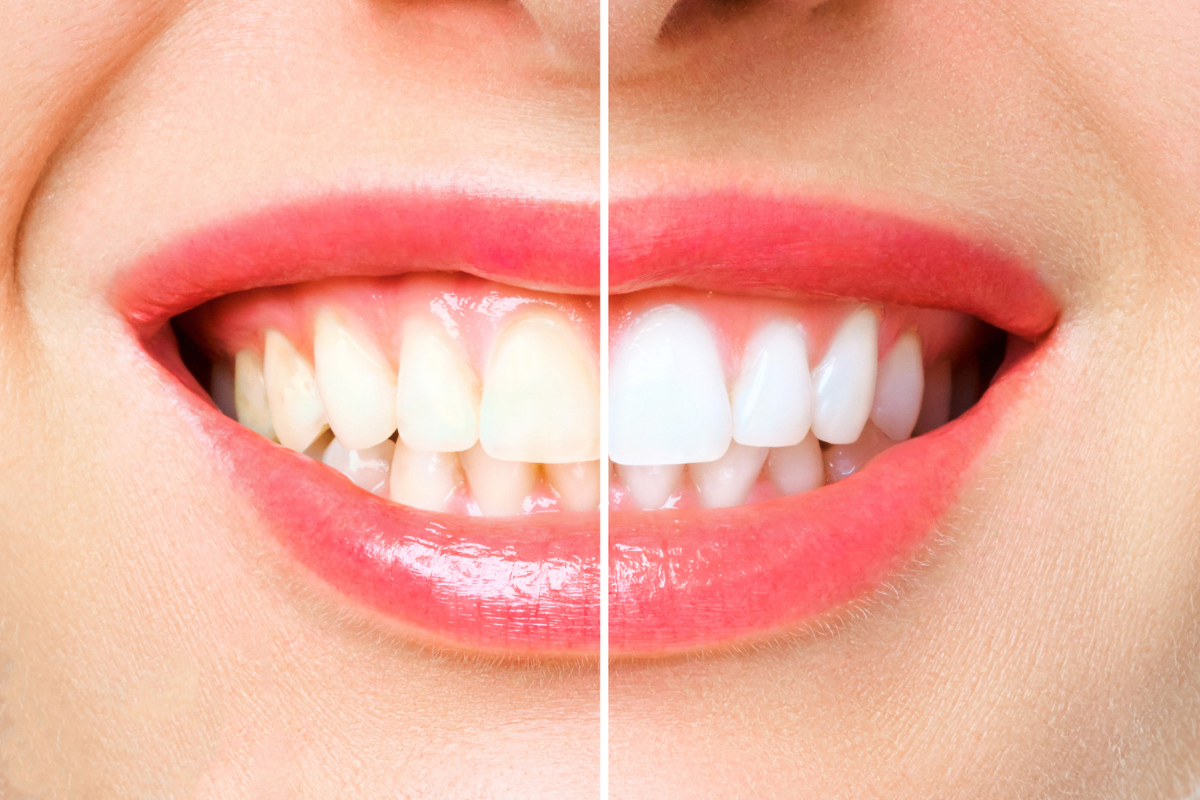 Are Teeth Whitening Safe, and Does It Work?
