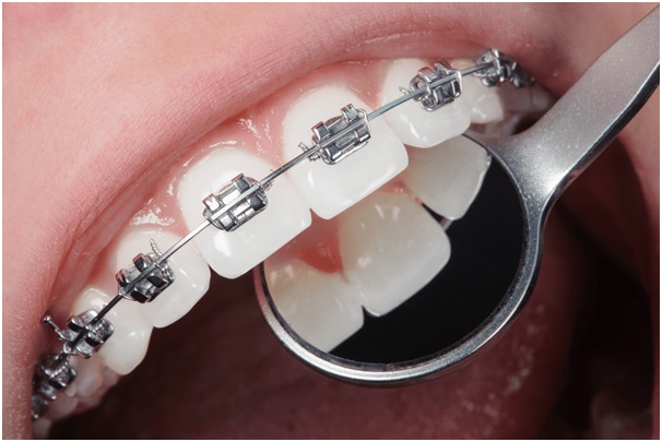 Unlock Your Perfect Smile: 10 Reasons Why Orthodontic Treatment is Worth Considering