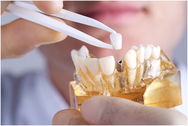 cost of dental implants in dubai